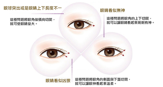 什么是立体双眼放大术？开眼头/眼尾/下眼睑下移