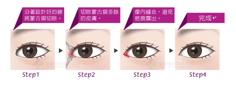 什么是立体双眼放大术？开眼头/眼尾/下眼睑下移