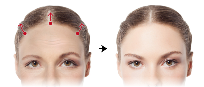 什么是内视镜前额拉皮手术？哪些情况需要做内视镜前额拉皮？