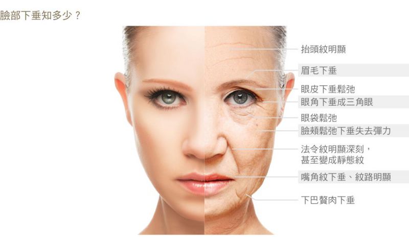 什么是内视镜前额拉皮手术？哪些情况需要做内视镜前额拉皮？