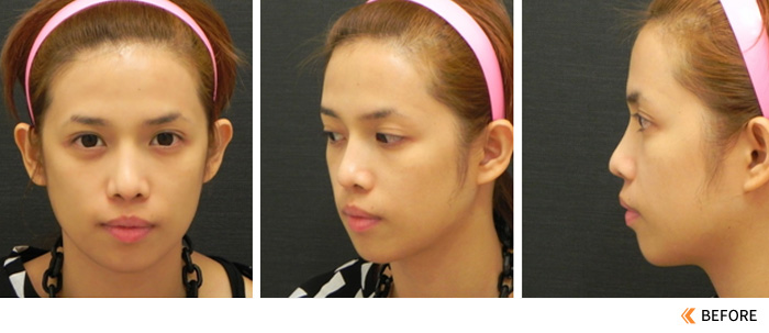 自体脂肪移植的存活率能达到50%到70% 脂肪可以二次移植吗？