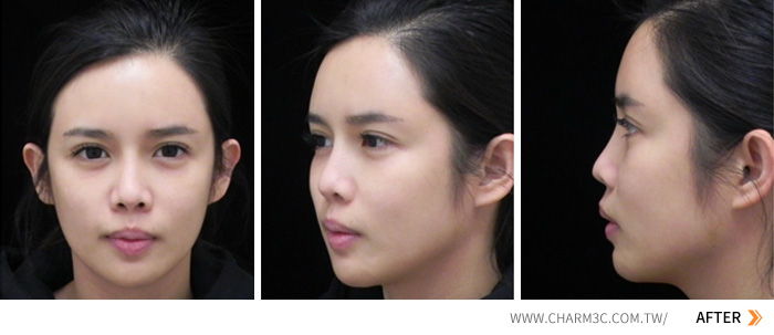 自体脂肪移植的存活率能达到50%到70% 脂肪可以二次移植吗？