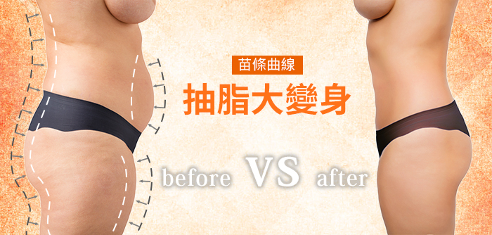 抽脂最好的手术方式：水刀抽脂【治疗方式】