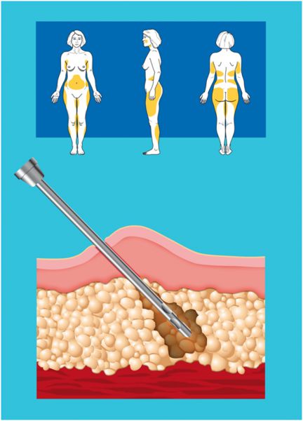 抽脂最好的手术方式：水刀抽脂【治疗方式】
