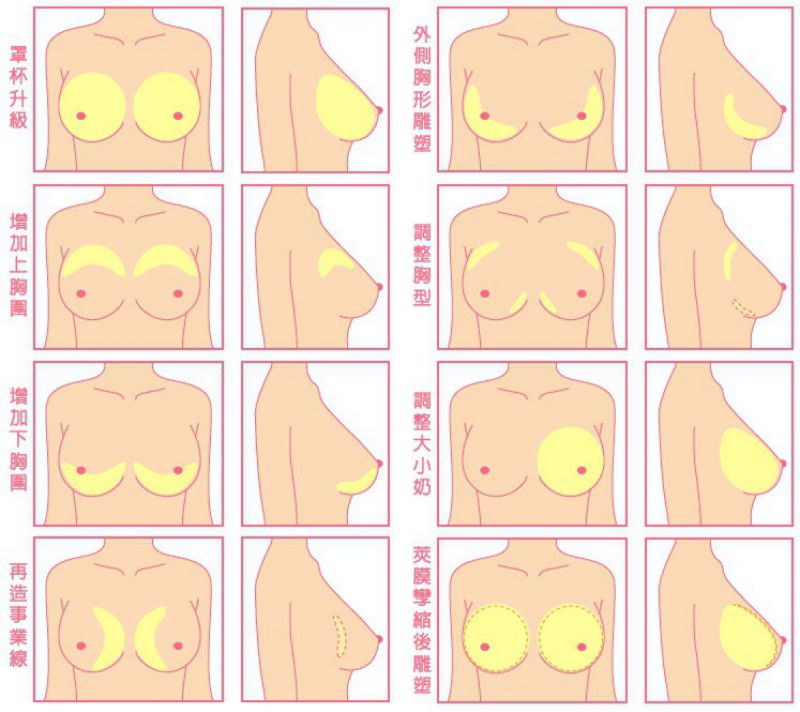 胸小平胸怎么办？最安全的丰胸方法：自体脂肪丰胸