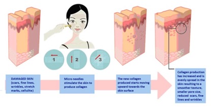 微针美肌活肤主要功能是什么？微针美肌活肤原理是什么？