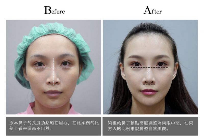 隆鼻、垫下巴，二次隆鼻、异体真皮隆鼻真实案例前后照片对比图