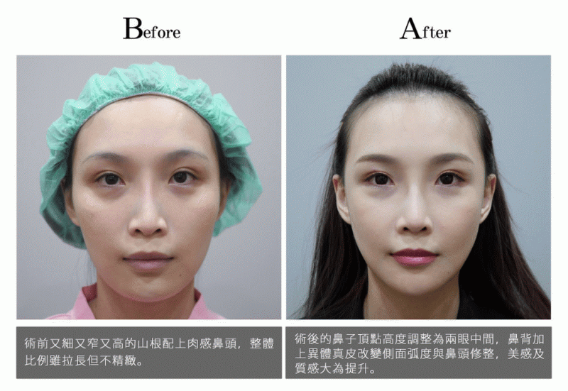 隆鼻、垫下巴，二次隆鼻、异体真皮隆鼻真实案例前后照片对比图