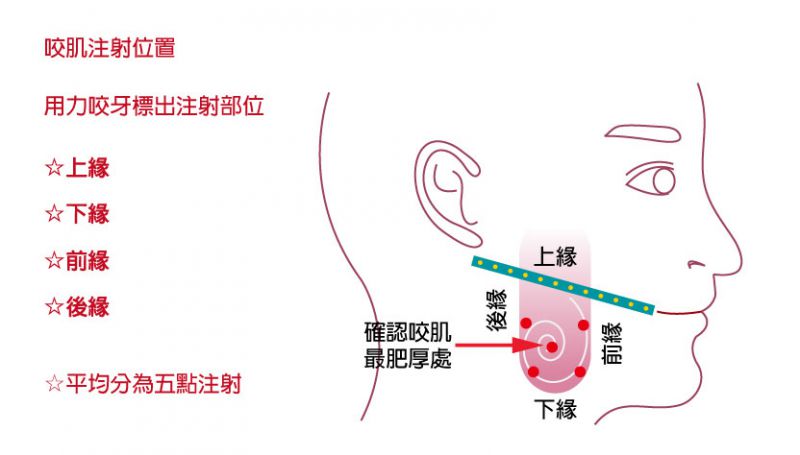注射肉毒杆菌（肉毒素）可以改善哪些问题？肉毒素除皱瘦脸