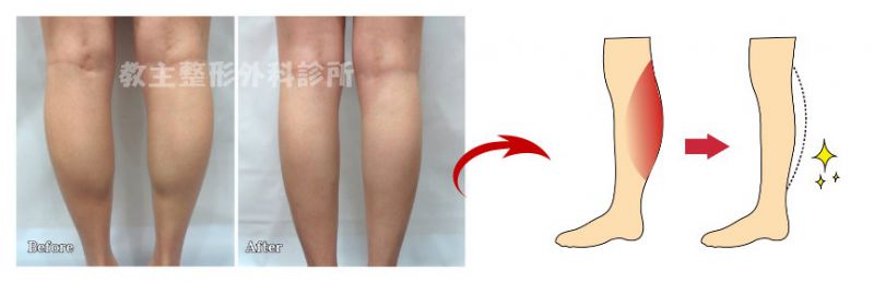 注射肉毒杆菌（肉毒素）可以改善哪些问题？肉毒素除皱瘦脸