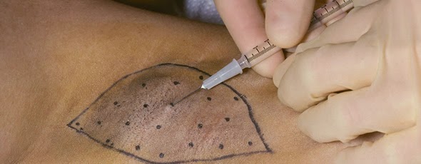 注射肉毒杆菌（肉毒素）可以改善哪些问题？肉毒素除皱瘦脸