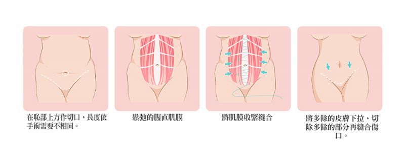 腹部拉皮可以一起做抽脂吗？腹部拉皮手术能消除妊娠纹吗？