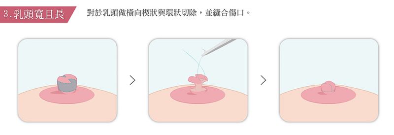 乳头变大的成因有哪些？缩乳头整形手术有哪些方式？