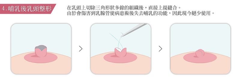 乳头变大的成因有哪些？缩乳头整形手术有哪些方式？