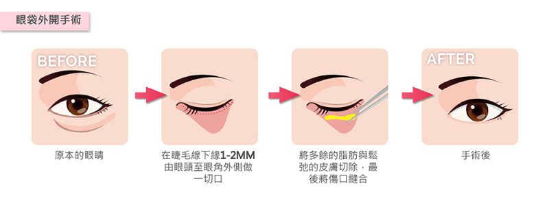 假如有眼袋的问题该怎么处理？有哪几种手术方式呢？