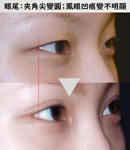 钉书针双眼皮(埋线双眼皮)+开眼头(开内眼角)+开眼尾(开外眼角)案例 钉书针双眼皮(埋线双眼皮)+开眼头(开内眼角)+开眼尾(开外眼角)案例