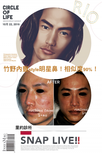 【 Goretex隆鼻+耳软骨鼻头+玻尿酸苹果肌矫正中脸凹陷】打造中国版竹野内丰!