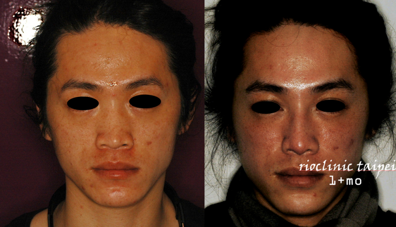 【 Goretex隆鼻+耳软骨鼻头+玻尿酸苹果肌矫正中脸凹陷】打造中国版竹野内丰!