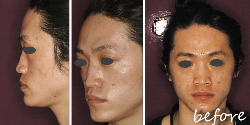 【 Goretex隆鼻+耳软骨鼻头+玻尿酸苹果肌矫正中脸凹陷】打造中国版竹野内丰!