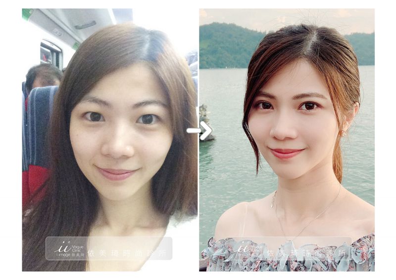 勾人电眼韩式双眼皮手术恢复期多久 韩式双眼皮案例