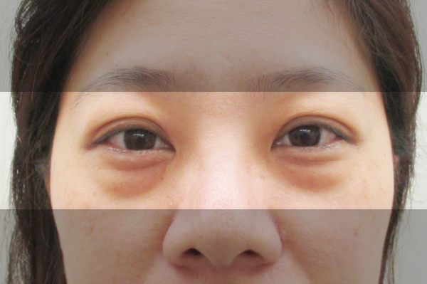 眼袋形成的原因到底是什么？全方位认识眼袋