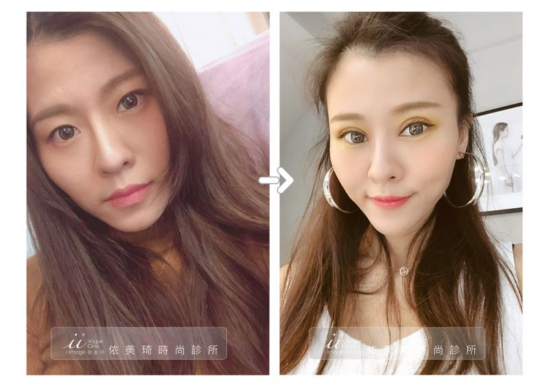 勾人电眼韩式双眼皮手术恢复期多久 韩式双眼皮案例