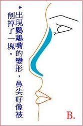 传统L型鼻膜隆鼻可能发生的缺点和并发症有哪些？