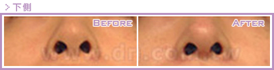 二次隆鼻手术(隆鼻修复、隆鼻重修)的原因是什么?鼻修复案例真实图片 二次隆鼻手术(隆鼻修复、隆鼻重修)的原因是什么?鼻修复案例真实图片