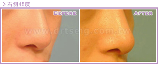 二次隆鼻手术(隆鼻修复、隆鼻重修)的原因是什么?鼻修复案例真实图片 二次隆鼻手术(隆鼻修复、隆鼻重修)的原因是什么?鼻修复案例真实图片