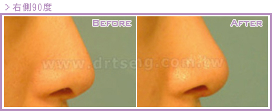 二次隆鼻手术(隆鼻修复、隆鼻重修)的原因是什么?鼻修复案例真实图片 二次隆鼻手术(隆鼻修复、隆鼻重修)的原因是什么?鼻修复案例真实图片