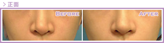 二次隆鼻手术(隆鼻修复、隆鼻重修)的原因是什么?鼻修复案例真实图片 二次隆鼻手术(隆鼻修复、隆鼻重修)的原因是什么?鼻修复案例真实图片