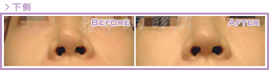 二次隆鼻手术(隆鼻修复、隆鼻重修)的原因是什么?鼻修复案例真实图片 二次隆鼻手术(隆鼻修复、隆鼻重修)的原因是什么?鼻修复案例真实图片