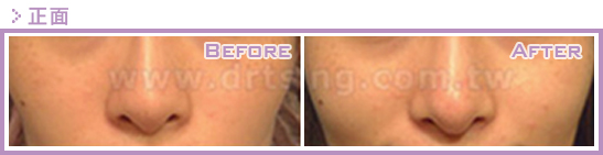 二次隆鼻手术(隆鼻修复、隆鼻重修)的原因是什么?鼻修复案例真实图片 二次隆鼻手术(隆鼻修复、隆鼻重修)的原因是什么?鼻修复案例真实图片