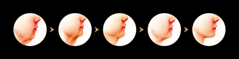 Profound魔方电波除皱系统是什么？Profound魔方电波除皱原理