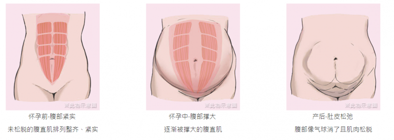 产后为什们腹部会松弛撑大？腹部拉皮手术有疤痕和切口吗？