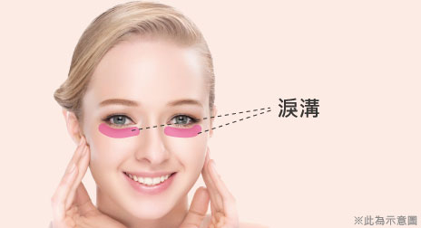 全面自体脂肪移植填充苹果肌额头太阳穴泪沟解决方案