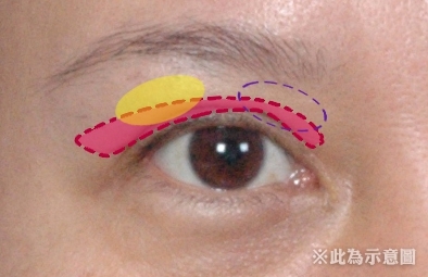 该如何选择适合自己的双眼皮手术？为什么选择割双眼皮？