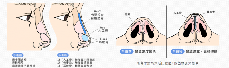隆鼻手术切口位置与手术方法是怎么样的？