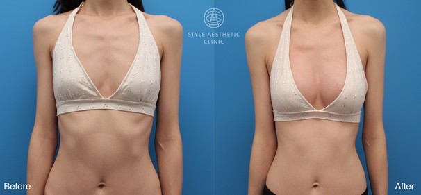 乳晕隆胸真实案例完全过程：YY的比基尼圆梦计画