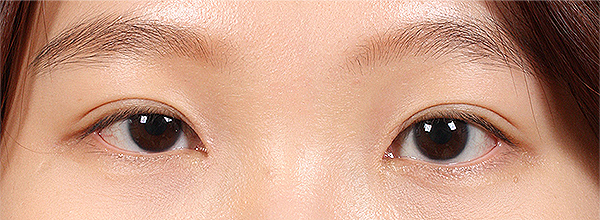 为什么要开眼头（开内眼角）？传统开眼角会有疤痕吗？