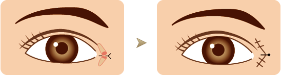 为什么要开眼头（开内眼角）？传统开眼角会有疤痕吗？