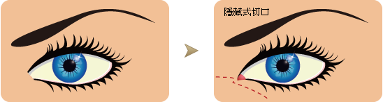 为什么要开眼头（开内眼角）？传统开眼角会有疤痕吗？