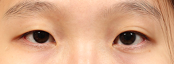 为什么要开眼头（开内眼角）？传统开眼角会有疤痕吗？