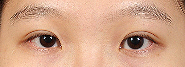 为什么要开眼头（开内眼角）？传统开眼角会有疤痕吗？