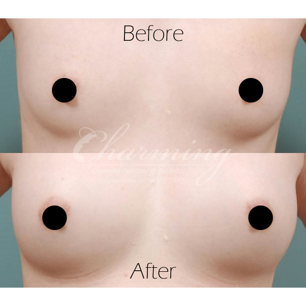 胸隆是什么意思?胸隆就是把胸隆大吗?把胸隆大的几个手术方式真实案例 胸隆是什么意思?胸隆就是把胸隆大吗?把胸隆大的几个手术方式真实案例