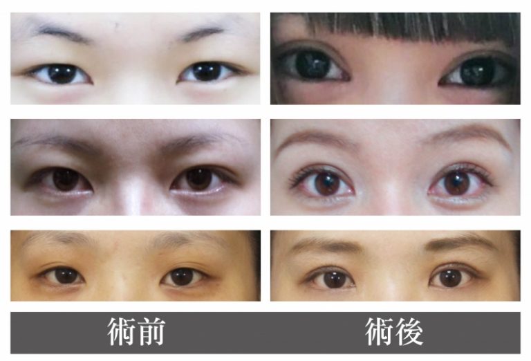 眼皮松弛提眼睑肌无力大小眼泡泡眼适合哪种双眼皮手术? 眼皮松弛提眼睑肌无力大小眼泡泡眼适合哪种双眼皮手术?