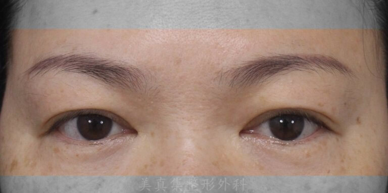 眼皮下垂怎么办？双眼皮下垂做提眉手术可以解决吗？