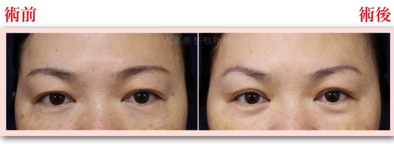 眼皮下垂怎么办？双眼皮下垂做提眉手术可以解决吗？