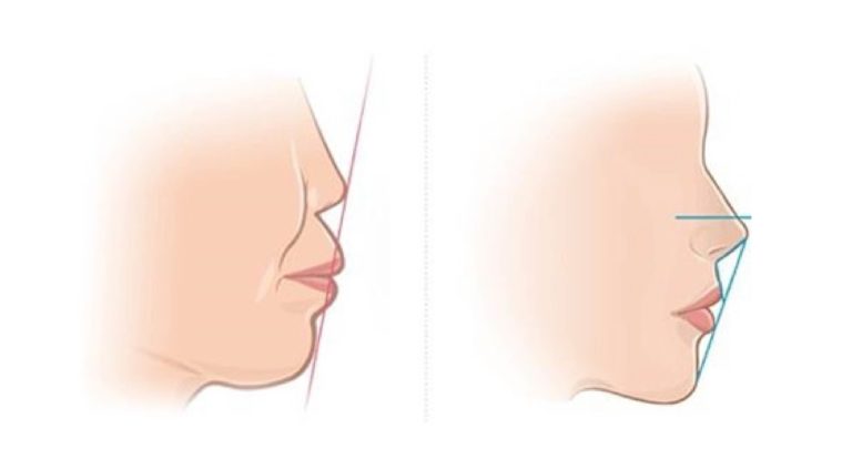为什么要进修缩唇手术？少了一点嘴型更美 缩唇手术简介
