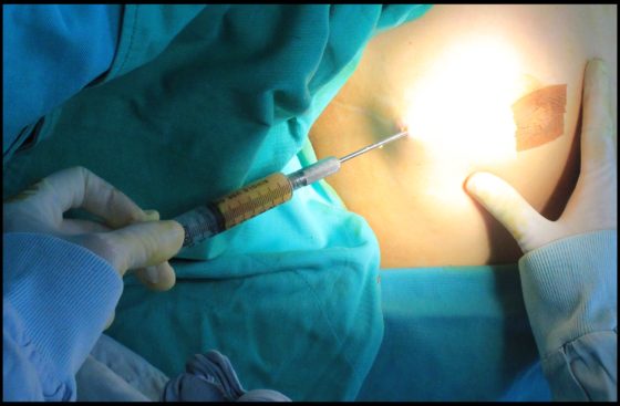 大腿抽脂和自体脂肪隆胸能一起做吗？